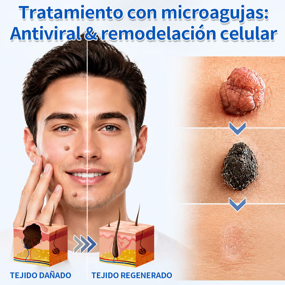 ✨Curalona® Parche 2 en 1 de Microneedles e Hidrocoloide🍀 | Elimina lunares elevados, acné, verrugas planas y fibromas cutáneos | Ayuda a mejorar arrugas, cicatrices e imperfecciones | Parches invisibles para rostro y cuerpo