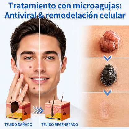 ✨Curalona® Parche 2 en 1 de Microneedles e Hidrocoloide🍀 | Elimina lunares elevados, acné, verrugas planas y fibromas cutáneos | Ayuda a mejorar arrugas, cicatrices e imperfecciones | Parches invisibles para rostro y cuerpo