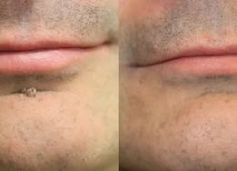 ✨Curalona® Parche 2 en 1 de Microneedles e Hidrocoloide🍀 | Elimina lunares elevados, acné, verrugas planas y fibromas cutáneos | Ayuda a mejorar arrugas, cicatrices e imperfecciones | Parches invisibles para rostro y cuerpo