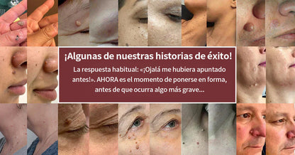 ✨Curalona® Parche 2 en 1 de Microneedles e Hidrocoloide🍀 | Elimina lunares elevados, acné, verrugas planas y fibromas cutáneos | Ayuda a mejorar arrugas, cicatrices e imperfecciones | Parches invisibles para rostro y cuerpo