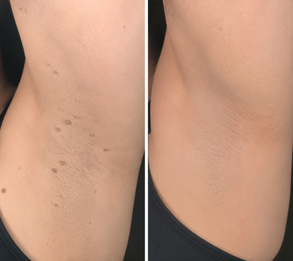 ✨Curalona® Parche 2 en 1 de Microneedles e Hidrocoloide🍀 | Elimina lunares elevados, acné, verrugas planas y fibromas cutáneos | Ayuda a mejorar arrugas, cicatrices e imperfecciones | Parches invisibles para rostro y cuerpo