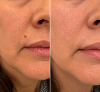 ✨Curalona® Parche 2 en 1 de Microneedles e Hidrocoloide🍀 | Elimina lunares elevados, acné, verrugas planas y fibromas cutáneos | Ayuda a mejorar arrugas, cicatrices e imperfecciones | Parches invisibles para rostro y cuerpo