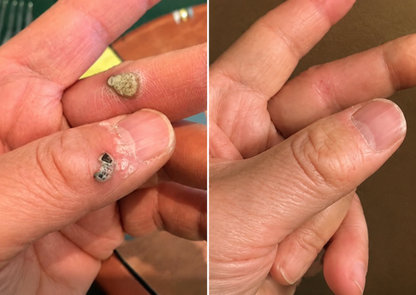 ✨Curalona® Parche 2 en 1 de Microneedles e Hidrocoloide🍀 | Elimina lunares elevados, acné, verrugas planas y fibromas cutáneos | Ayuda a mejorar arrugas, cicatrices e imperfecciones | Parches invisibles para rostro y cuerpo